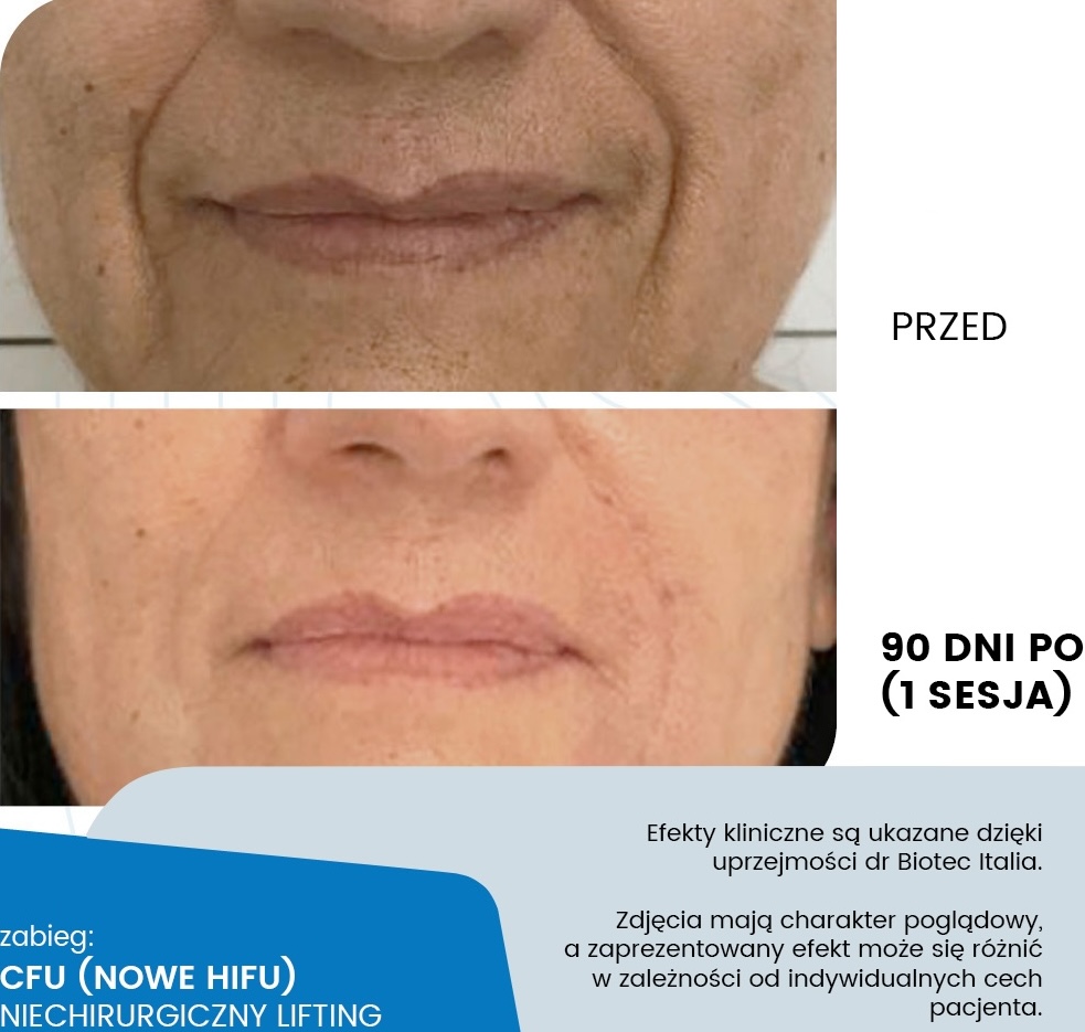 CFU - lifting ultradźwiękowy - efekt ujędrnienia skóry