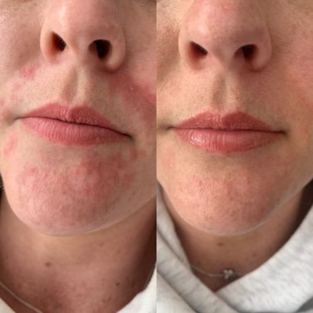 Dermalux Flex - efekt przed i po serii zabiegów (3)