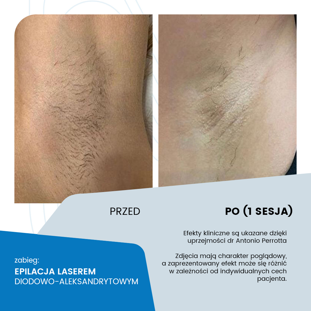Efekt epilacji laserowej pach - przed zabiegiem i po jednej sesji