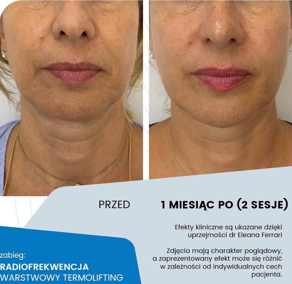 Termolifting RF monopolarna - przygotowanie do zabiegu