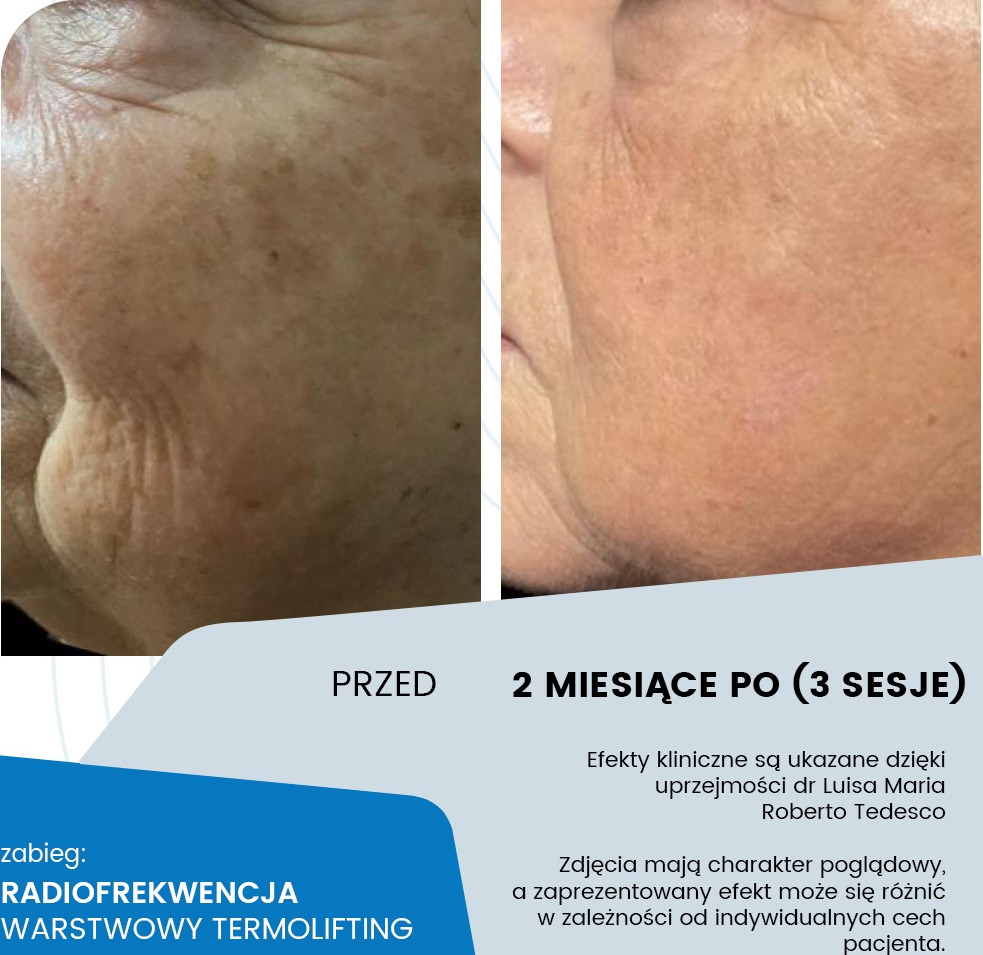 Termolifting RF monopolarna - etap zabiegowy